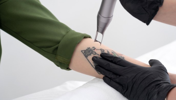 Cancellare i tatuaggi con il laser