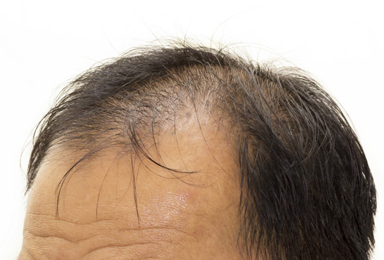 Calvizie maschile, trattamenti e costi DiLei