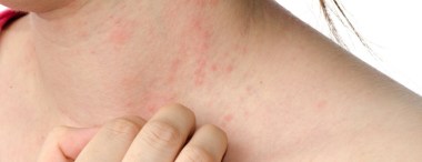 Allergie Alimentari Come Si Manifestano E Come Si Curano Dilei