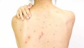 Fuoco di Sant’Antonio: cause, sintomi e trattamento