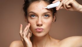 Acne: i rimedi naturali che possono aiutare