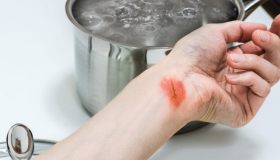Bruciature, scottature e piccoli ustioni: rimedi naturali