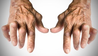 Artrite reumatoide: cos’è, cause e cure