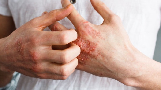 Eczema: definizione, cause e trattamenti