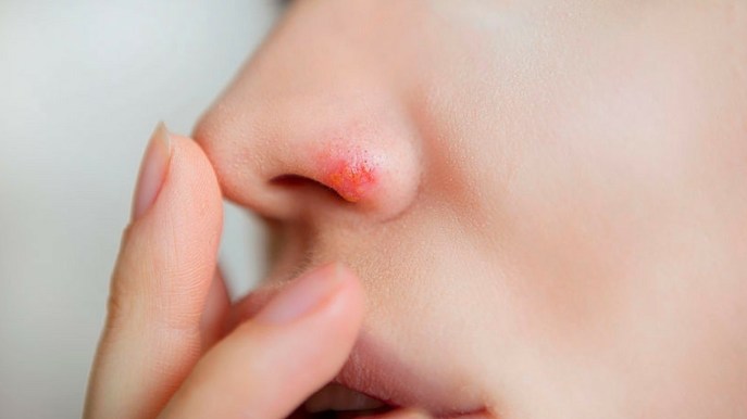 Herpes nasale: quali sono le cause, i sintomi e le terapie