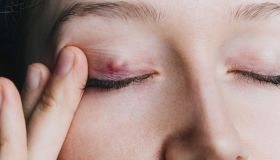 Calazio: cause, sintomi e come prevenirlo