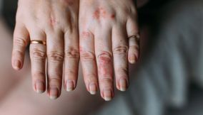 dermatite atopica
