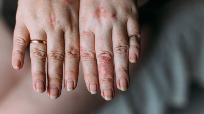 Dermatite atopica: definizione, perché si manifesta e quali sono le cause