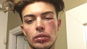 Stash picchiato per aver difeso una ragazza aggredita dal fidanzato