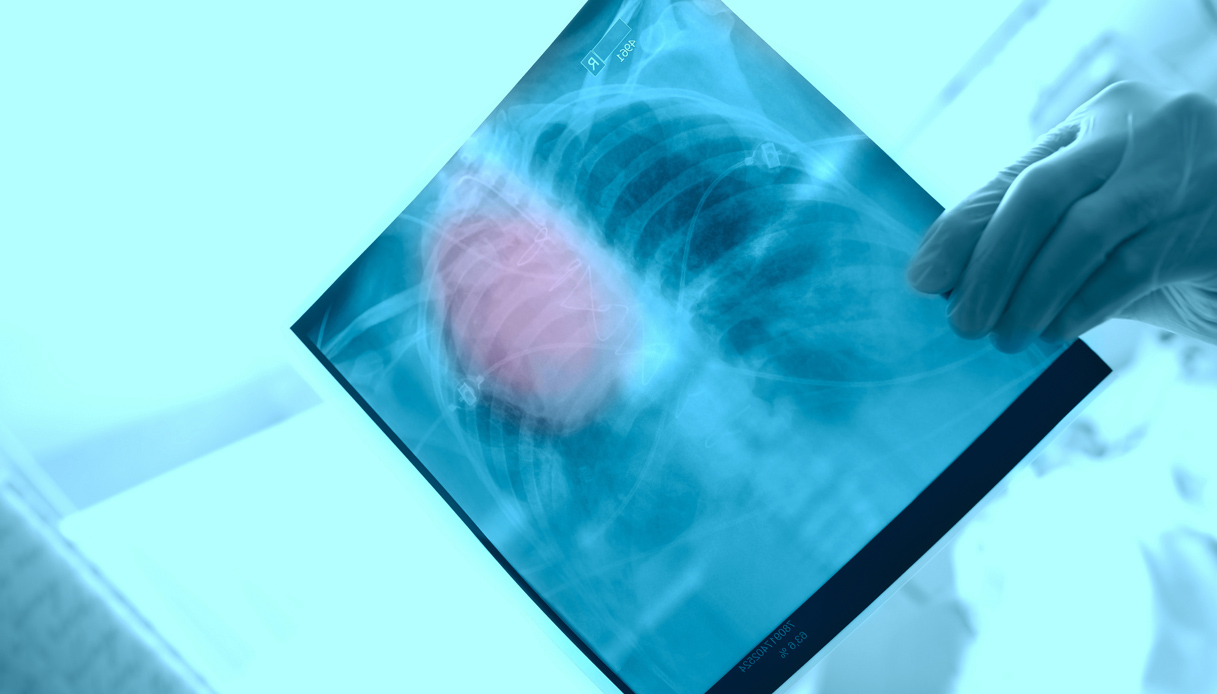 Epidemia di polmonite i sintomi, le cose da fare (e quelle da non fare)