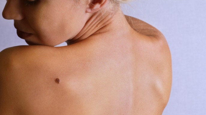 Come distinguere un melanoma dai nei normali