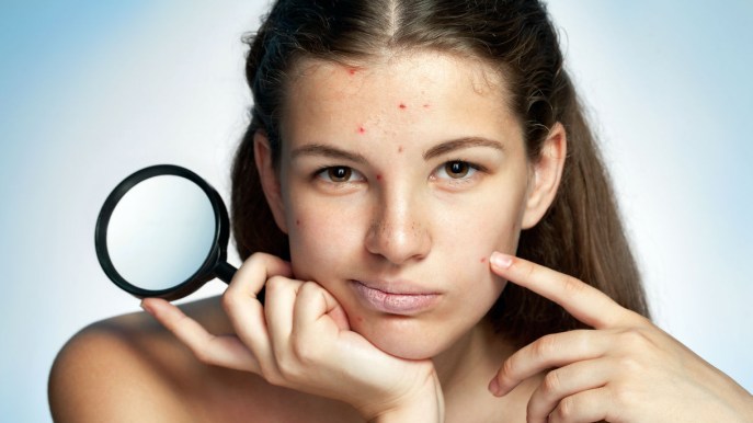 Come eliminare l’acne da stress in modo efficace