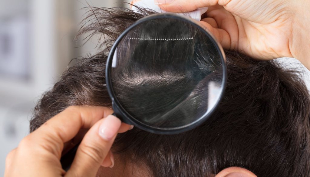 Pidocchi Sintomi Rimedi E Trattamento Dilei