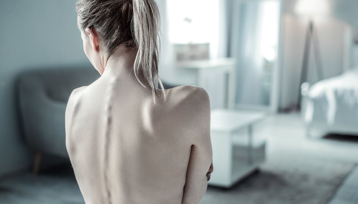 Anoressia: cos’è, come si manifesta e cosa fare