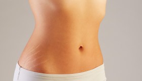 Smagliature e dieta quotidiana: esiste un legame?