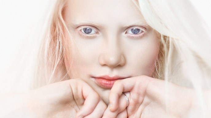 Albinismo, il candido mondo “a parte” che in pochi conoscono