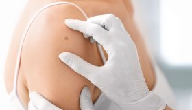 Le cheratosi seborroiche