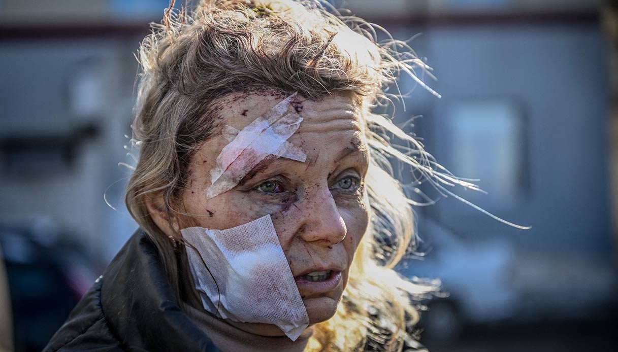 Donna ferita dopo l'invasione russa dell'Ucraina