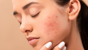 Acne, così in futuro affronteremo i “punti neri”