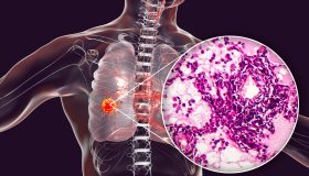 Tumore, il fumo è la principale causa di morte evitabile: come reagire