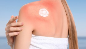 Estate, le regole di prevenzione per chi soffre di allergia cutanea