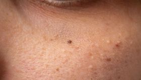 Grani di miglio o punti bianchi: cosa sono, cause e rimedi