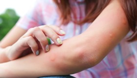 Punture d’insetti e shock anafilattico, come comportarsi