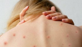 Mpox, vaiolo delle scimmie: cosa sapere, come si manifesta, cosa provoca