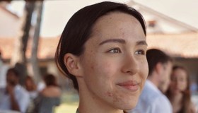 Aurora Ramazzotti e l’acne dopo il parto: la lezione di accettazione