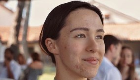 Aurora Ramazzotti, il viso segnato dall'acne