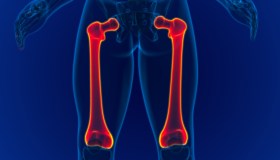 Frattura del femore, perché i rischi crescono con l’età e quanto pesa l’osteoporosi