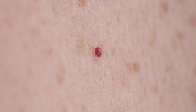 angioma