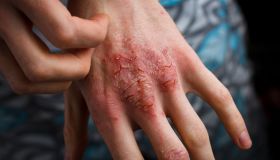 Dermatite: cos’è, sintomi, cause e tipi