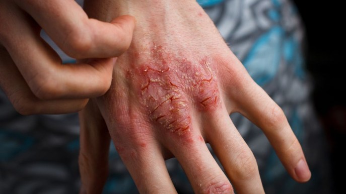 Dermatite: cos’è, sintomi, cause e tipi