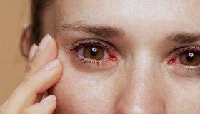 Arrossamento degli occhi: cause e rimedi