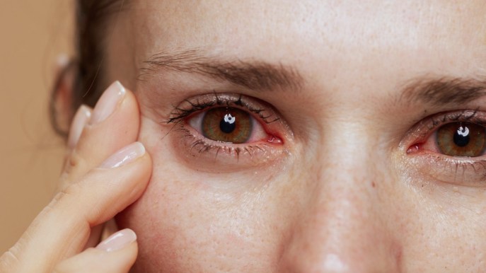 Arrossamento degli occhi: cause e rimedi