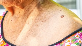 Basalioma: cos’è, sintomi, terapie