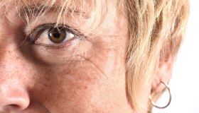 Cheratosi attinica: sintomi, terapia, prevenzione