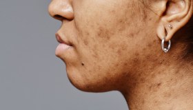 Cicatrici da acne: tipologie e rimedi