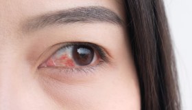 Congiuntivite allergica: come riconoscerla e curarla