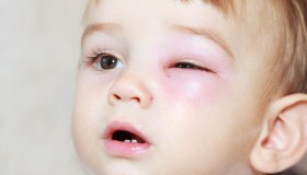 Dacriocistite: cause, sintomi e cura