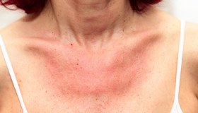 Dermatomiosite: cos’è, cause, sintomi, cura