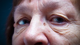 Ectropion: cos’è, cause, sintomi e cura