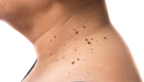 Fibromi penduli: cosa sono, come trattarli