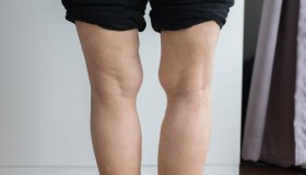 Ginocchio varo: cause, sintomi e cura