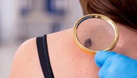 Melanoma: cos’è, sintomi, diagnosi, cura