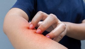 Micosi della pelle (funghi): cosa sono, sintomi, terapie