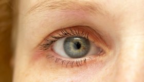 Neurite ottica: cos’è, sintomi, cause, cura