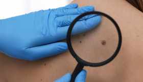 Nevo displastico: cause, sintomi e cura