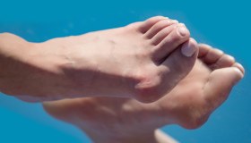 Piedi piatti: cosa sono, sintomi, come si curano